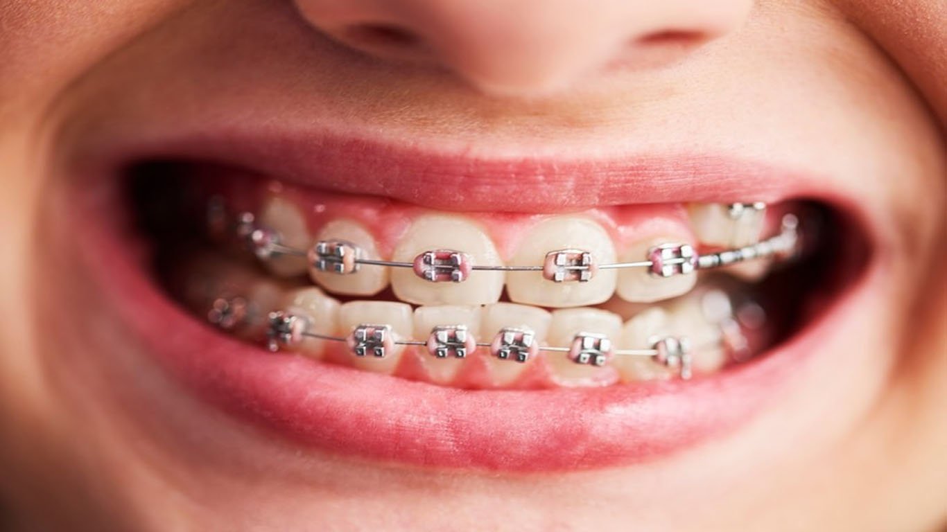 Metal Braces: Does This Traditional Dental Technology Have a Future?