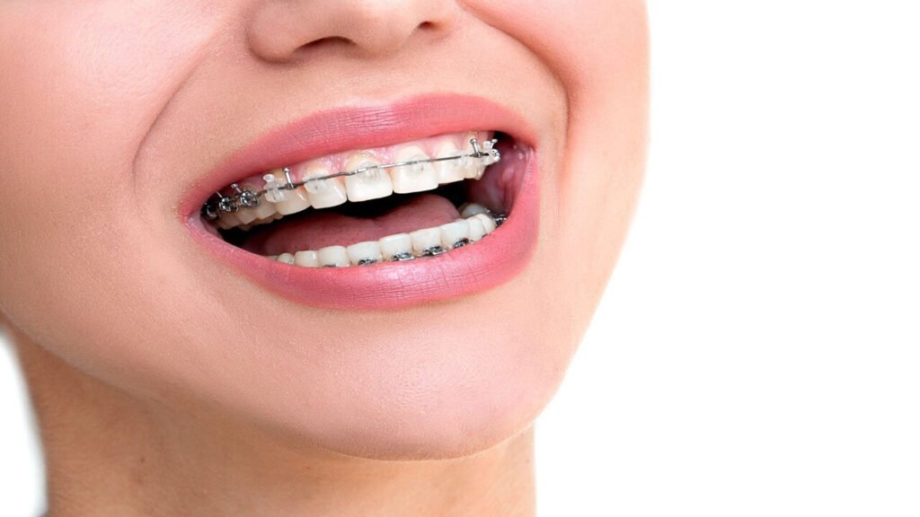 Damon Braces Vs. Traditional Braces Which One Is Right For You?