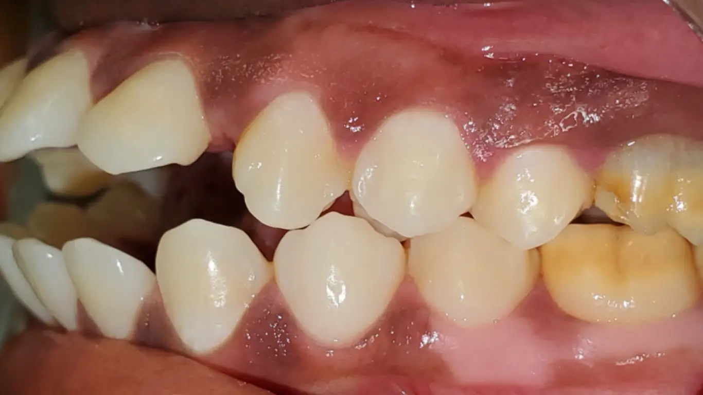 misaligned teeth-open bite