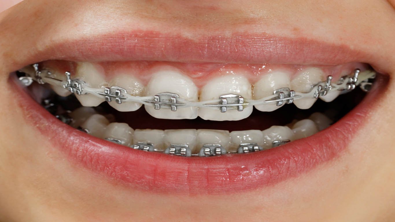 Fundamental Differences – Damon Braces vs Traditional Braces « Evolution  Orthodontics