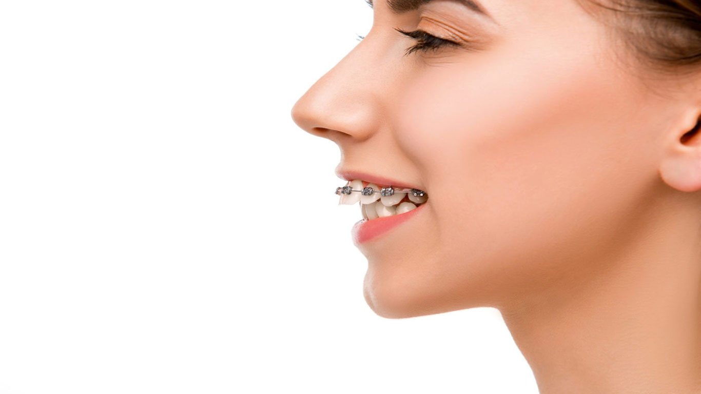 Damon Braces Vs. Traditional Braces: Which One Is Right For You?