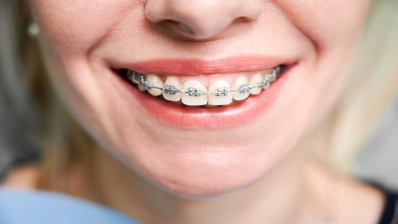 Who Should Consider Traditional Braces?