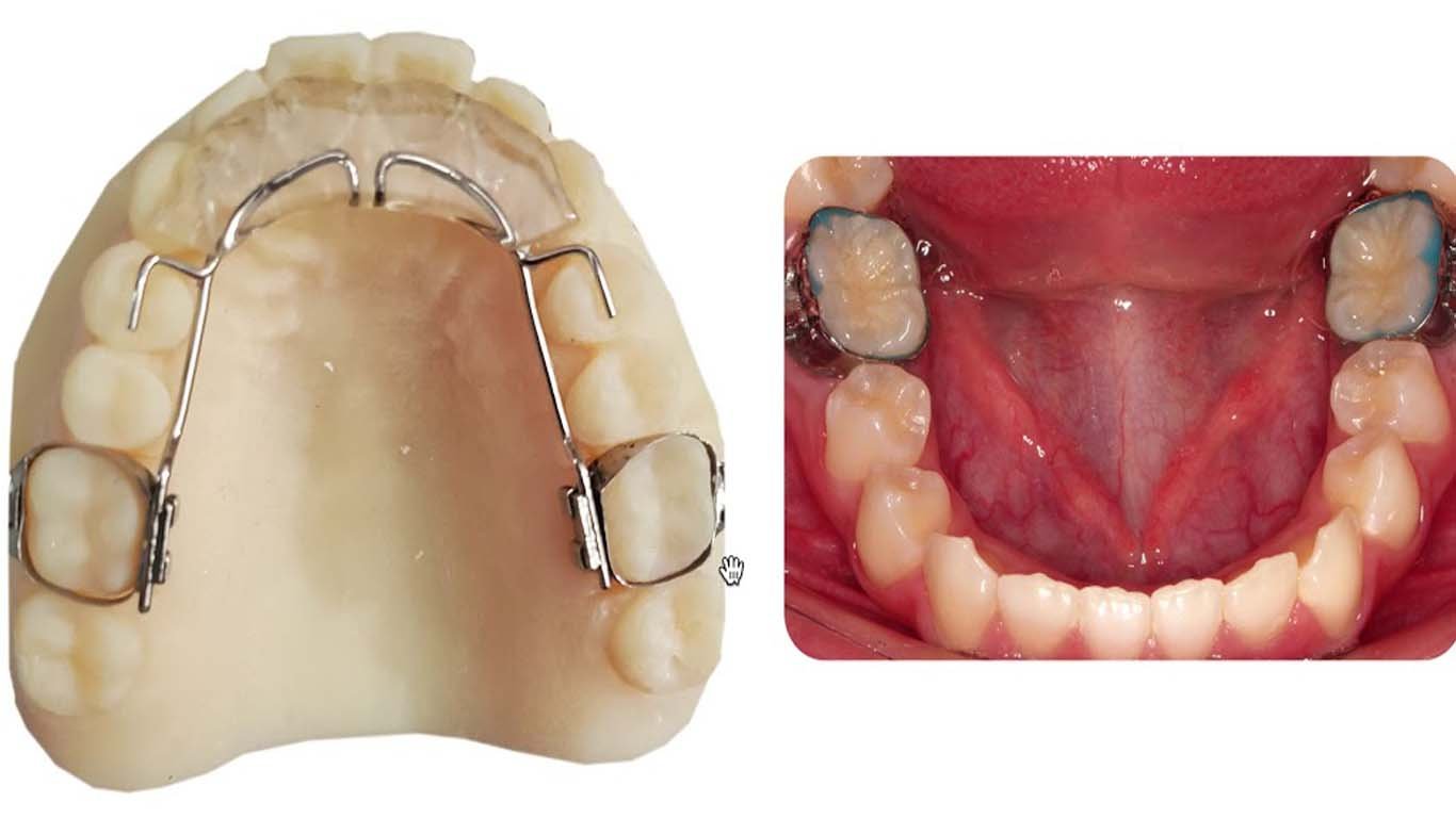 molar band pain-pain relief