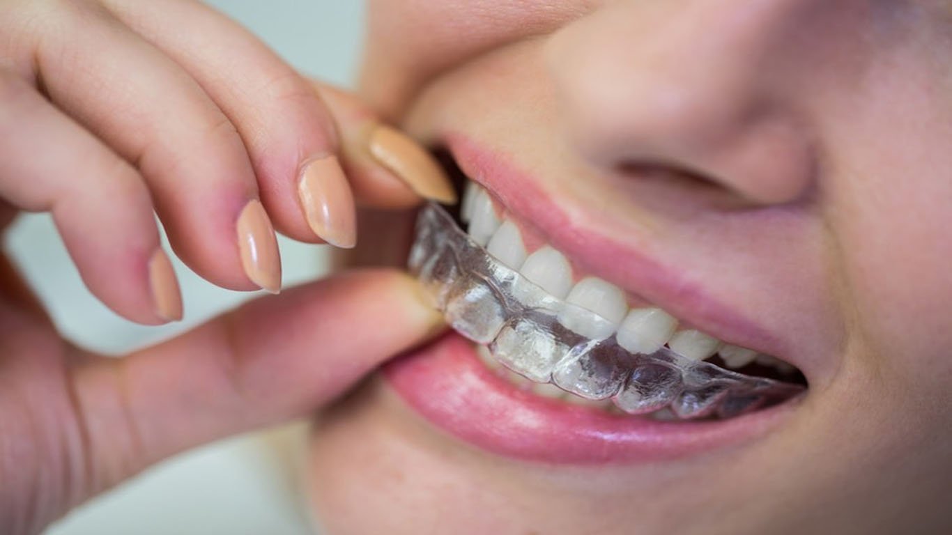 Invisalign vs Braces: Which is Better? - Thornhill Dental Office