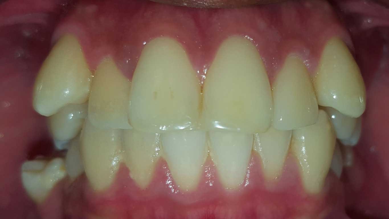Snaggletooth-Crowding- Can Invisalign Solve it?