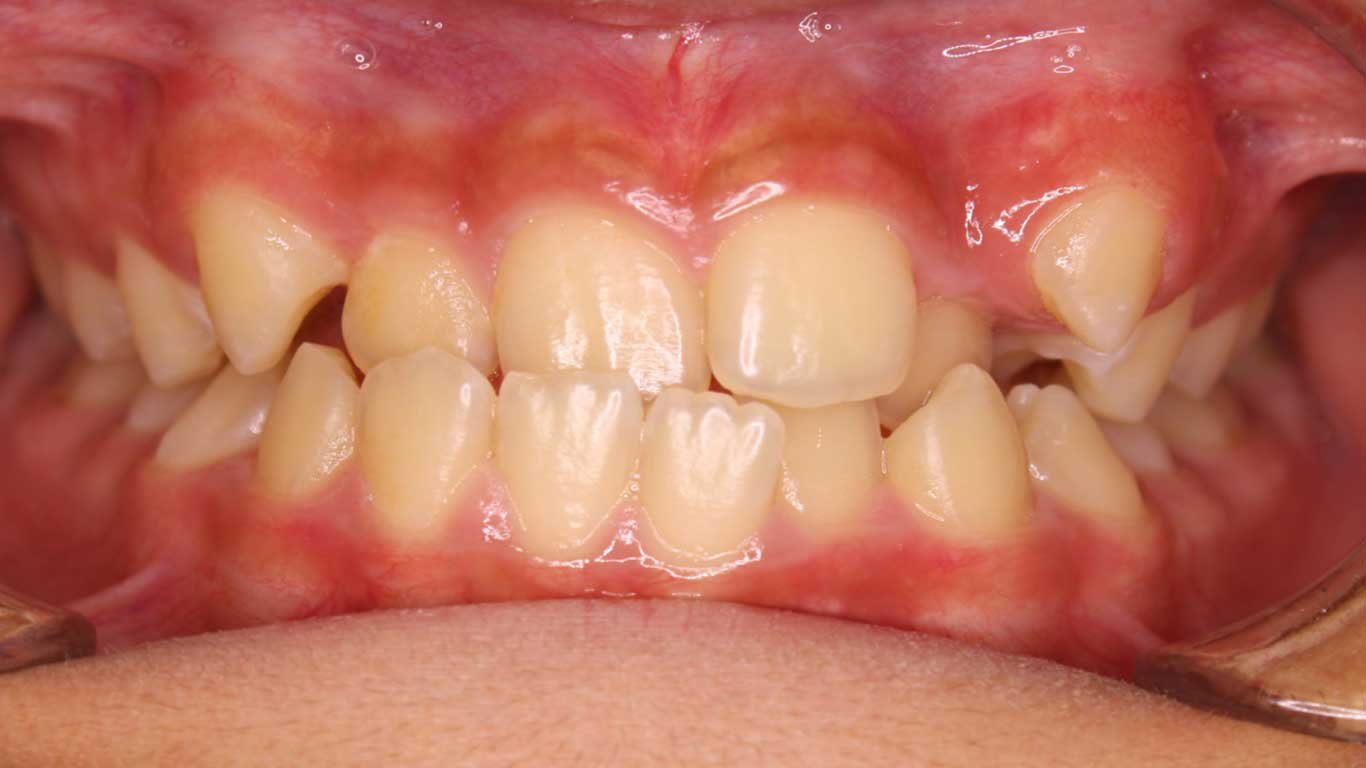 Anterior crossbite- crooked teeth
