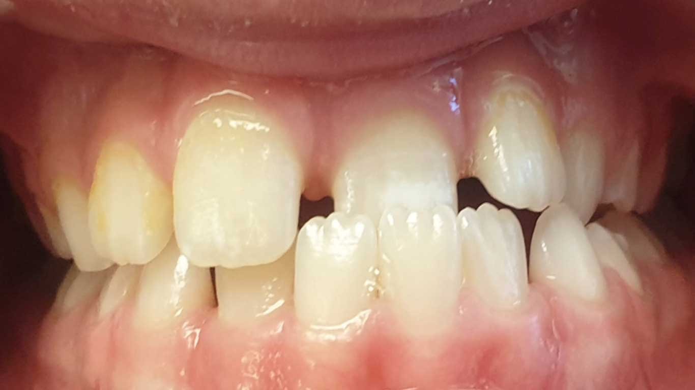 crooked teeth treatment