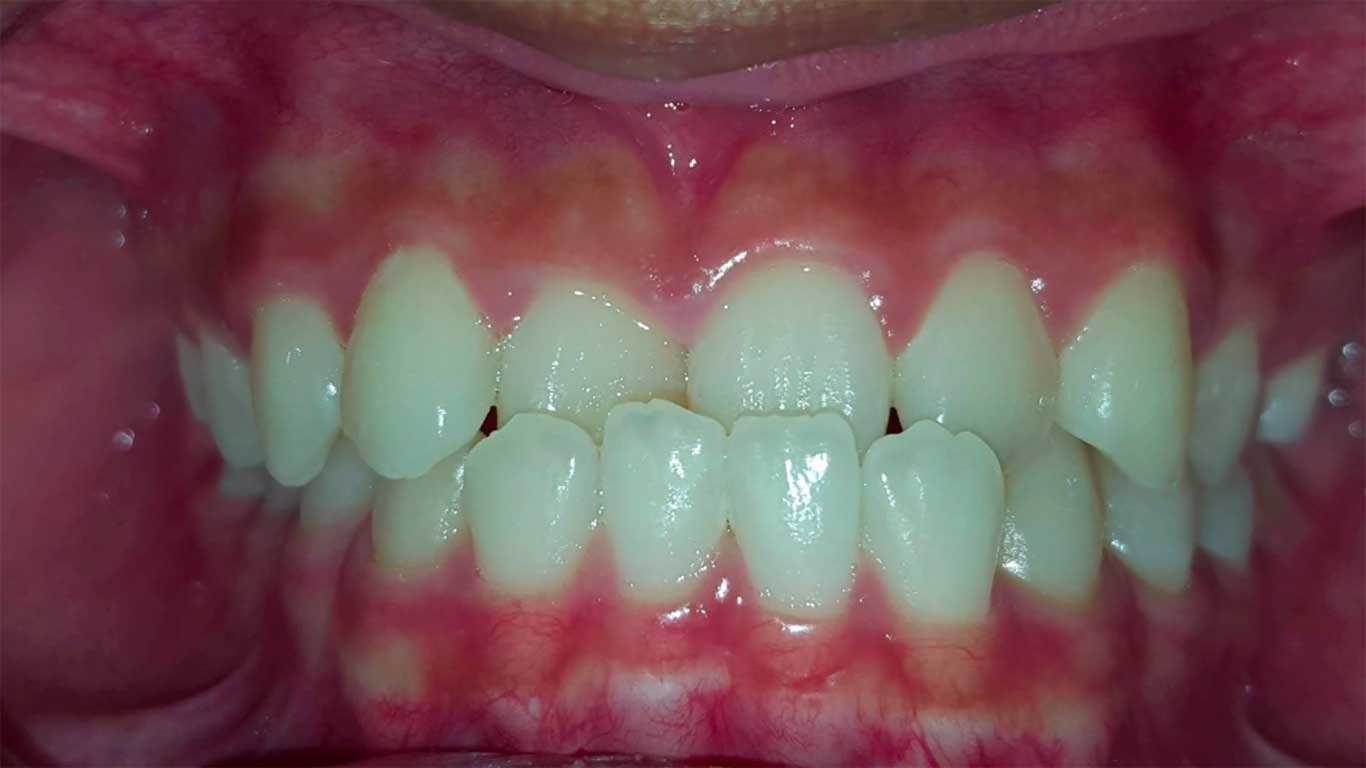 Crossbite issue- Crooked teeth