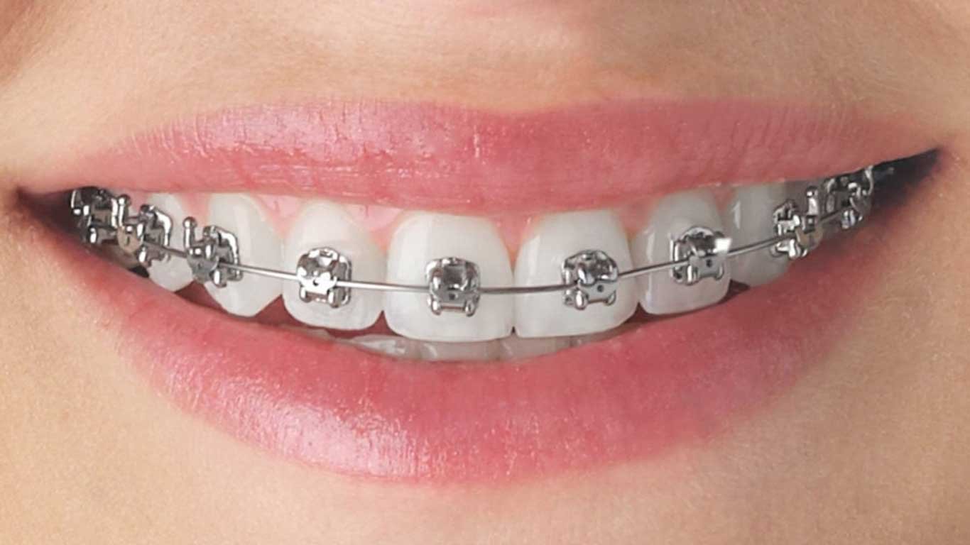 metal braces-one common treatment for crokked teeth