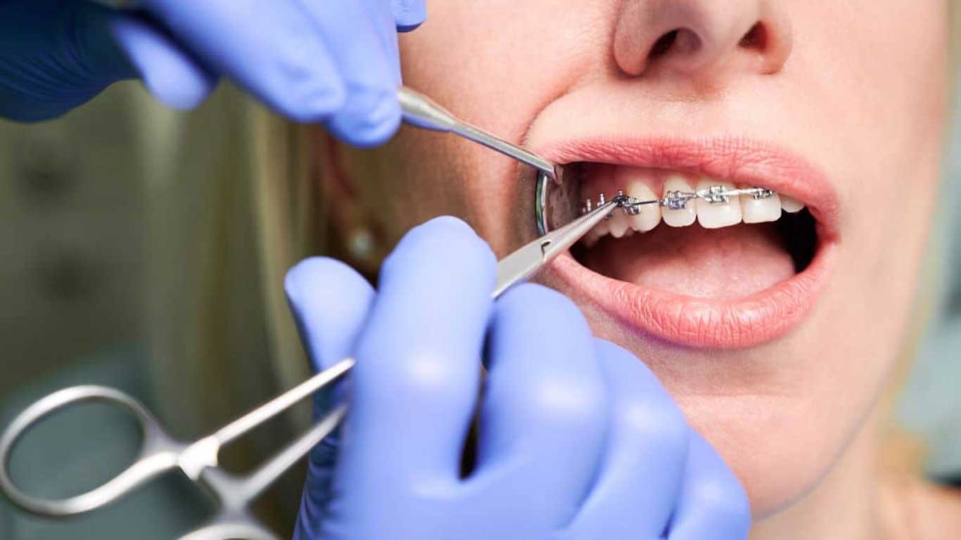 Why Choose an Orthodontist for Your Perfect Smile?