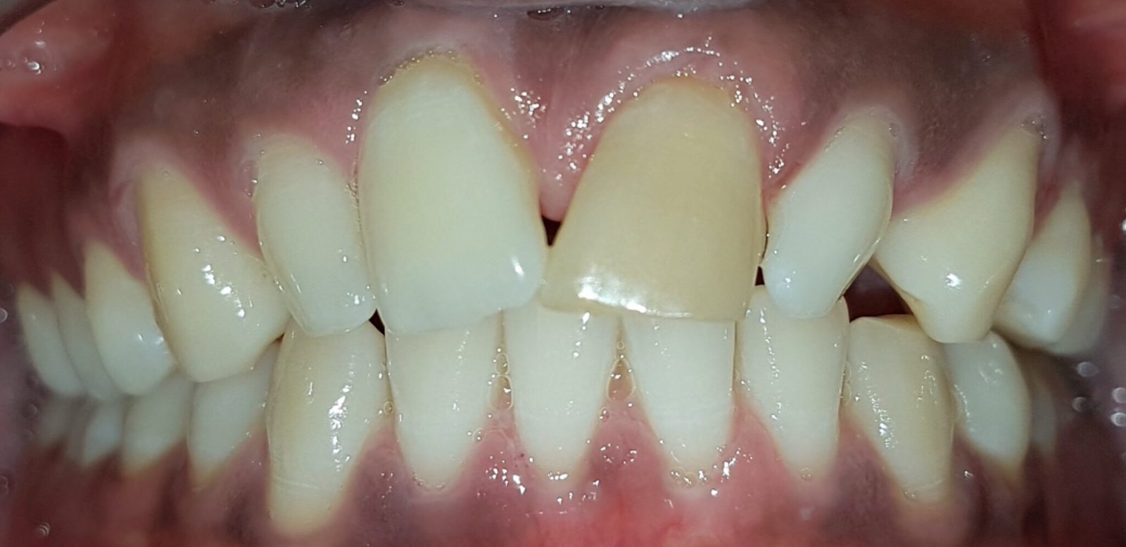 Max Frontal Intraoral Photo