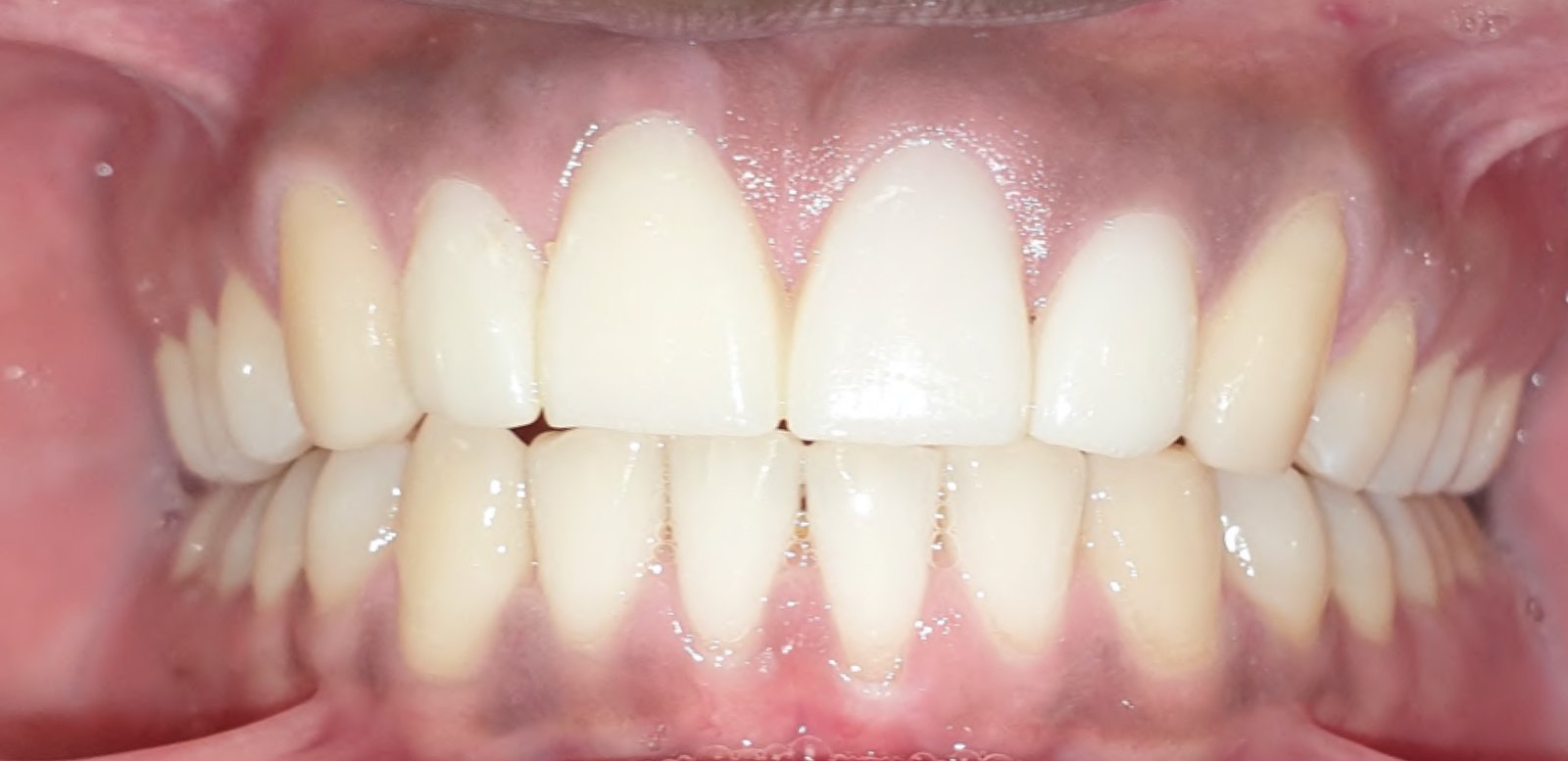 Max final Frontal Intraoral Photo