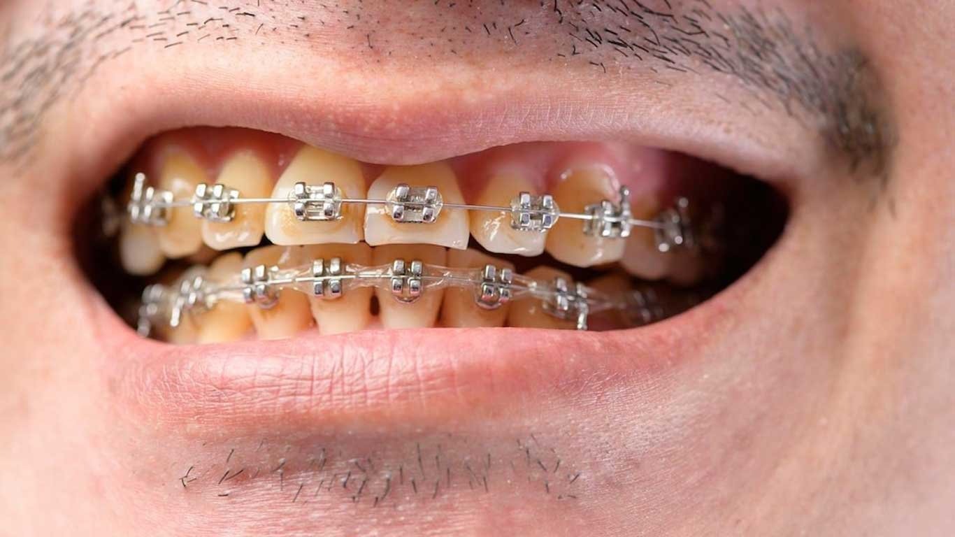 traditional metal braces for treatment misalignmnets issues