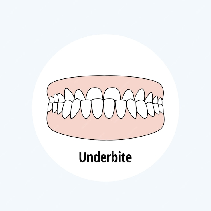 Class III malocclusion (underbite)