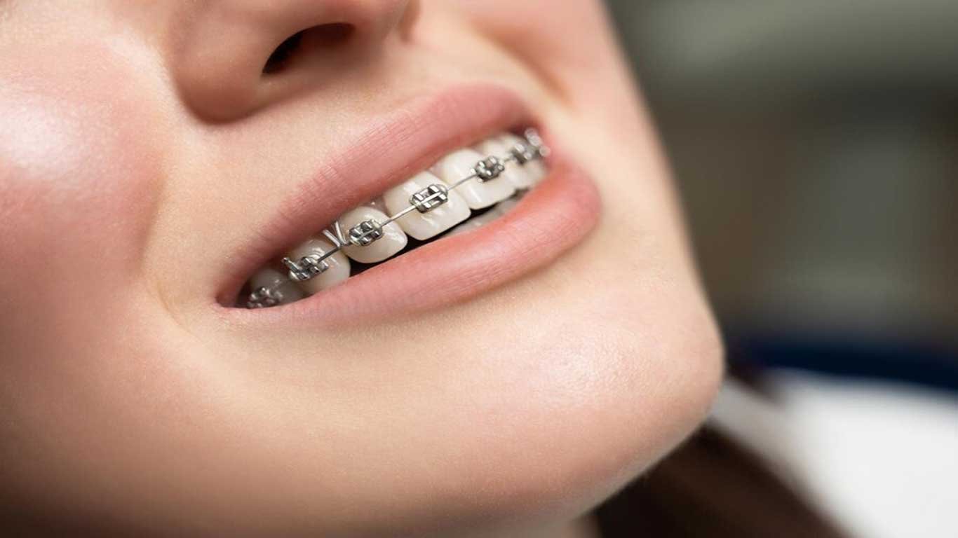 Adult Orthodontics