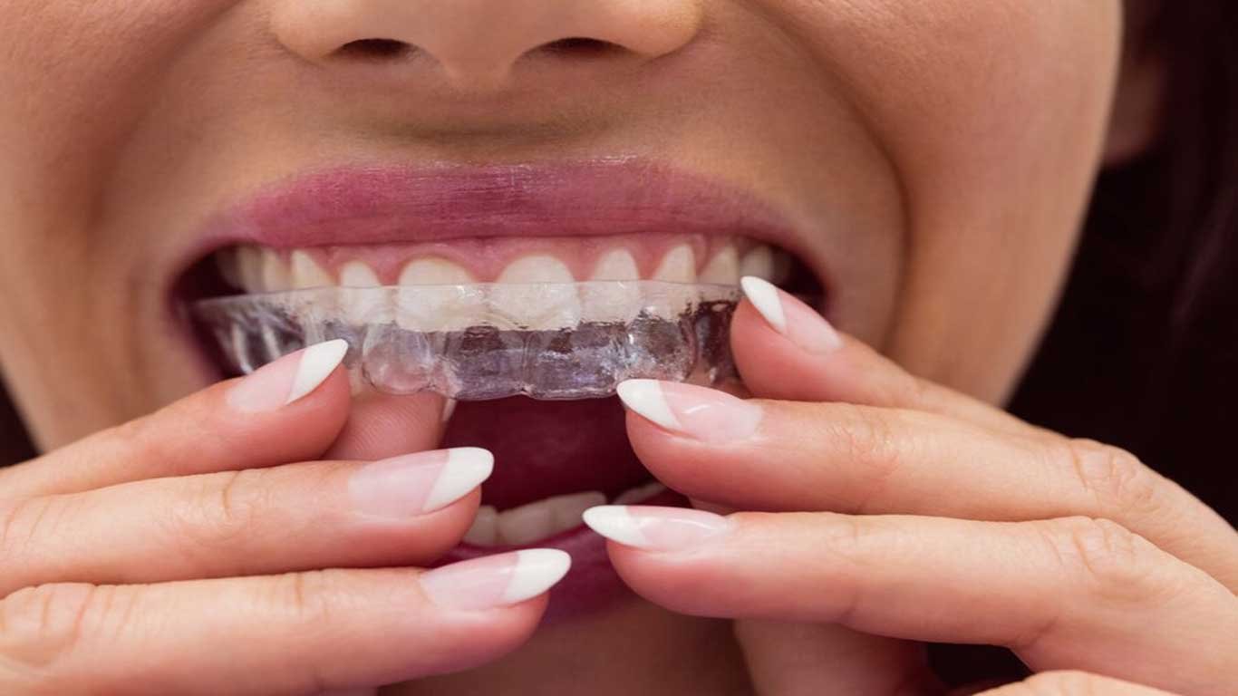 orthodontic treatment for adults- Invisalign