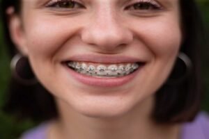 Orthodontic treatment for adults