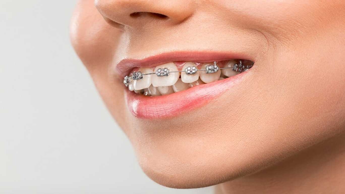 braces for adults-Orthodontic Treatment for Adults