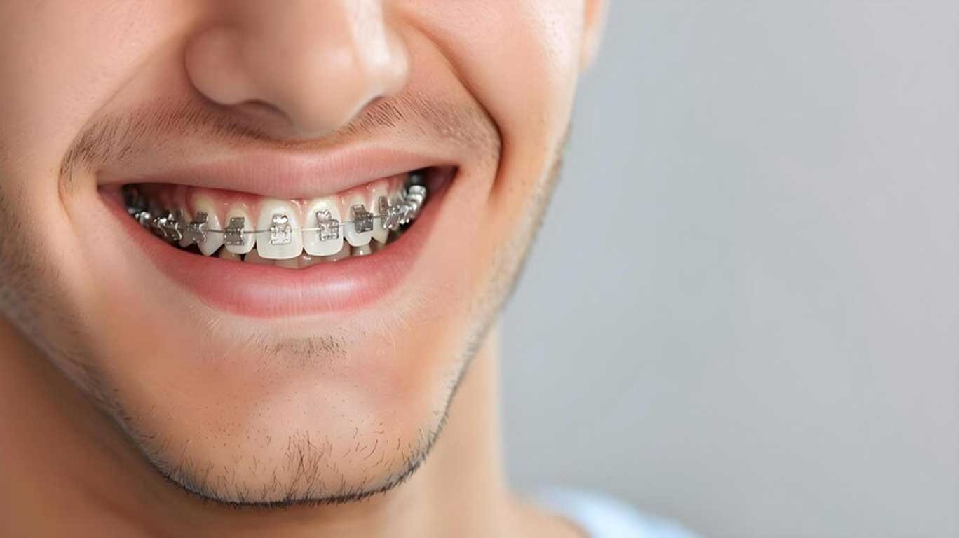 Are Braces More Painful for Adults