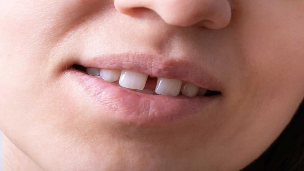 Diastema Teeth