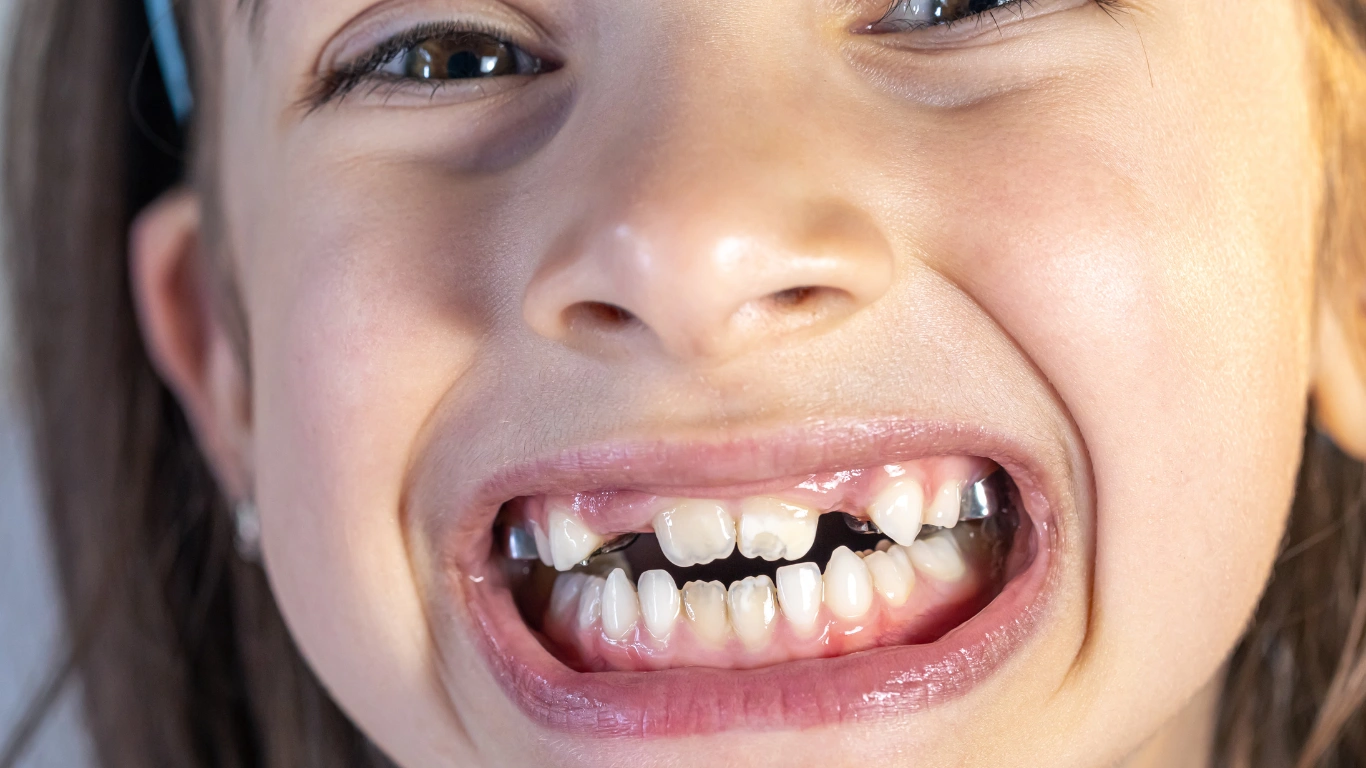 crooked canine teeth in human