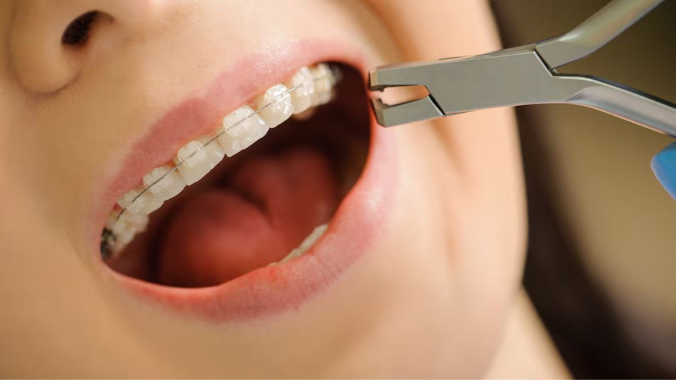 kinds of braces- ceramic braces