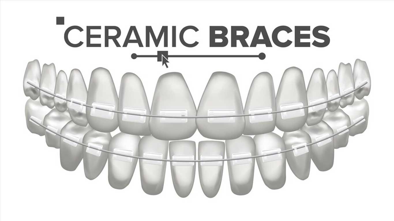 adult ceramic braces