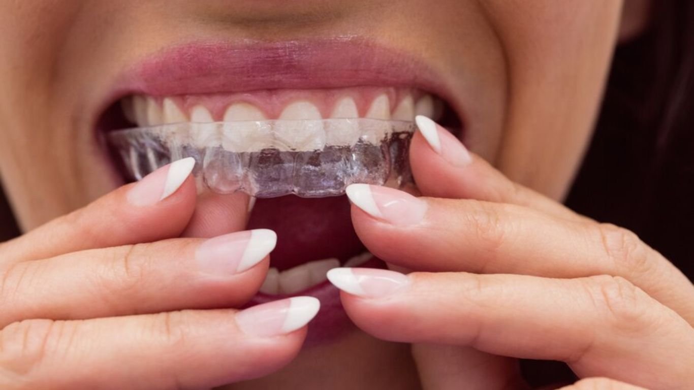 Different kinds of Braces: Clear Aligners