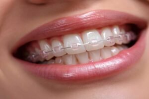 ceramic orthodontic brackets