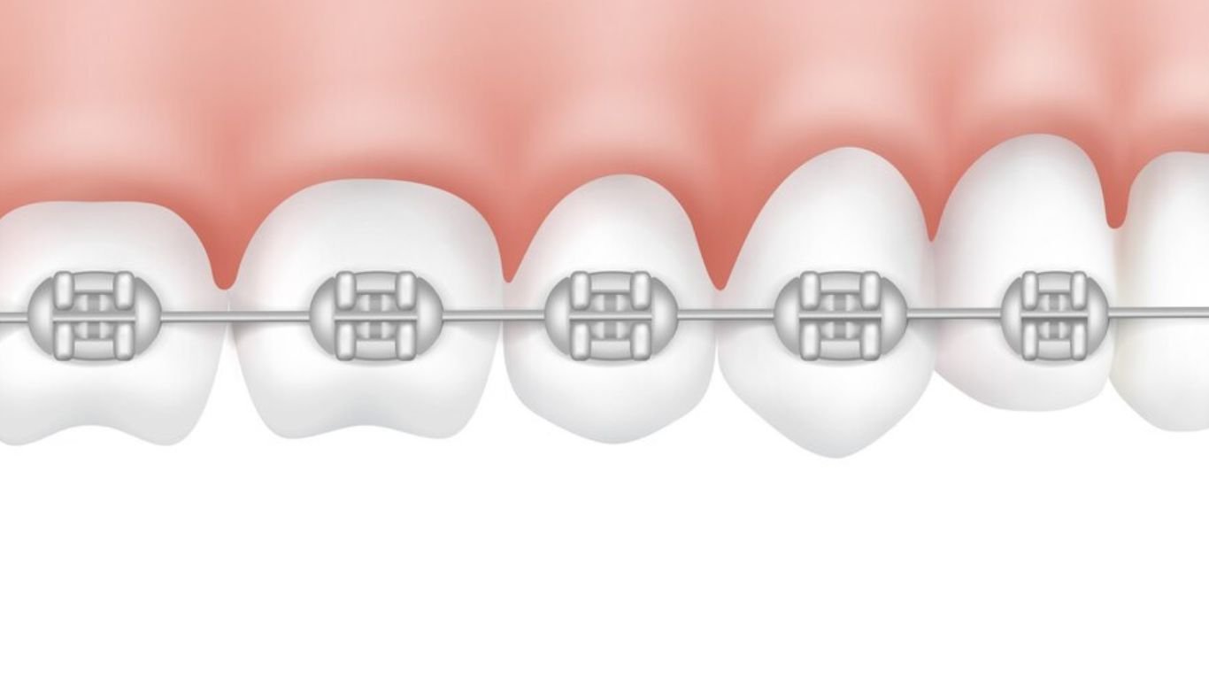 Different Types of Braces: Self-Ligating Braces