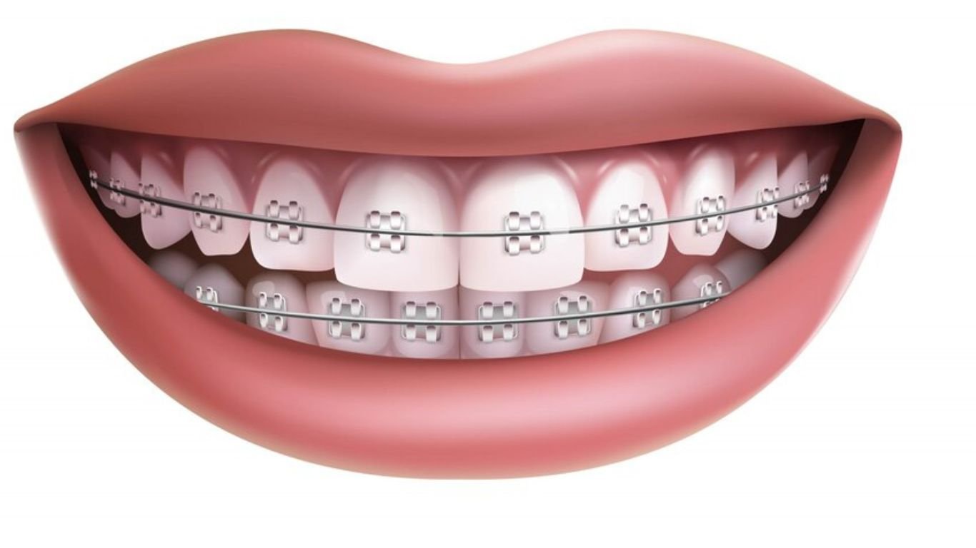 best braces for adults