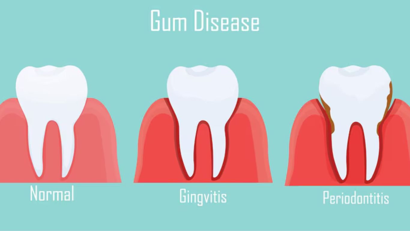 Gum disease