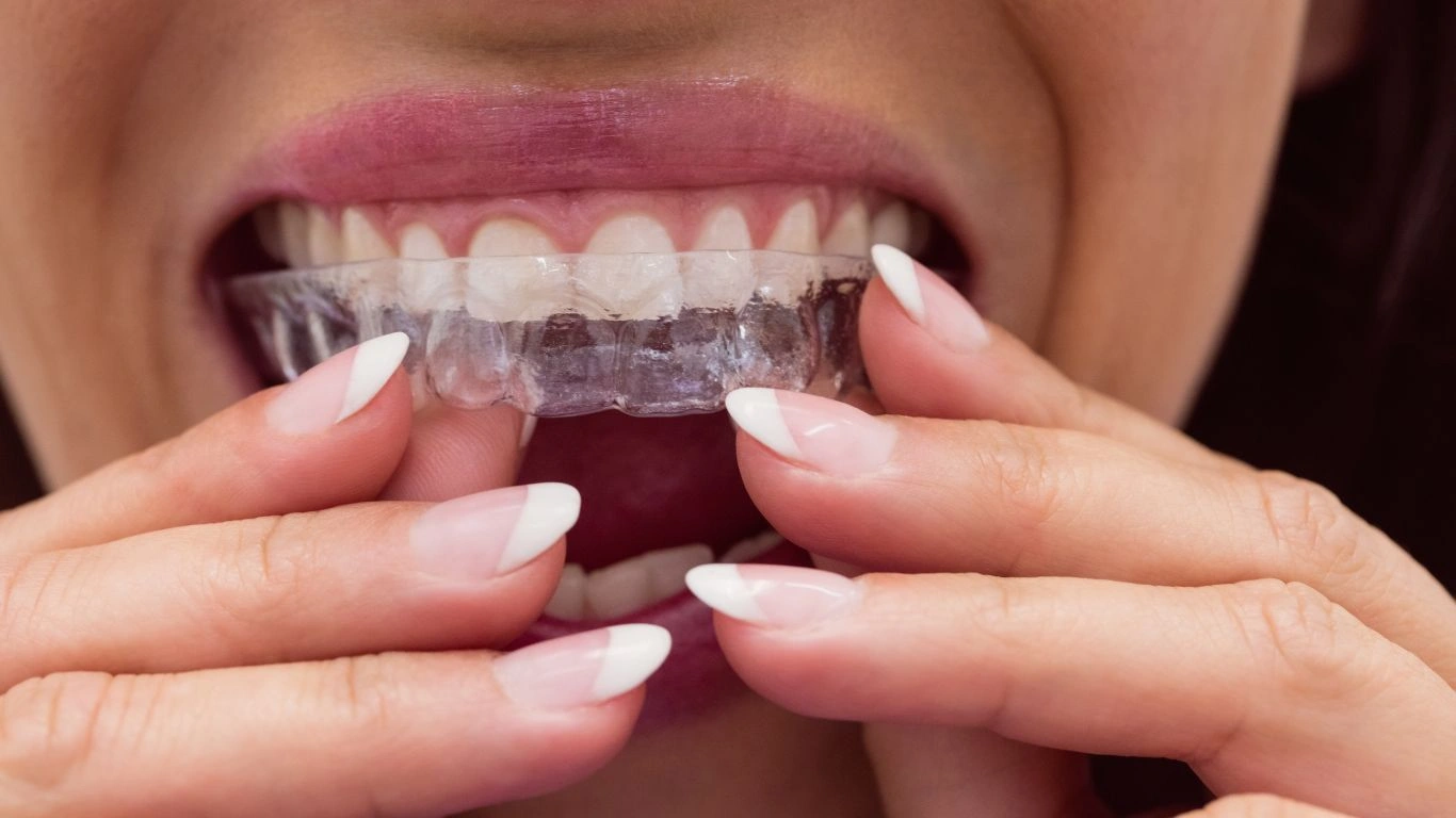 Invisalign consultation