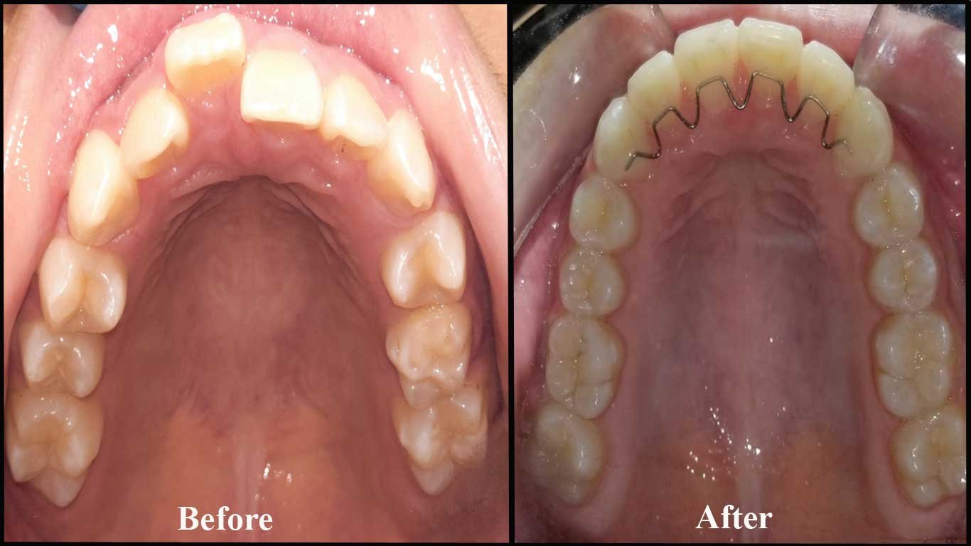 misaligned upper front teeth- dental braces before after