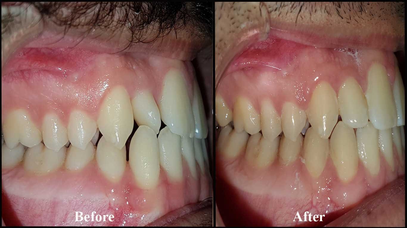 Anterior Crossbite -orthodontic braces before and after