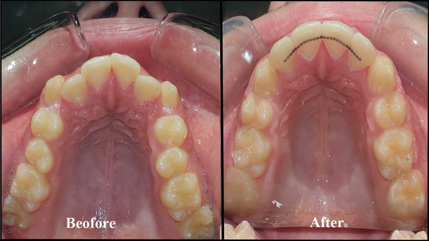 crowding- adult braces before after