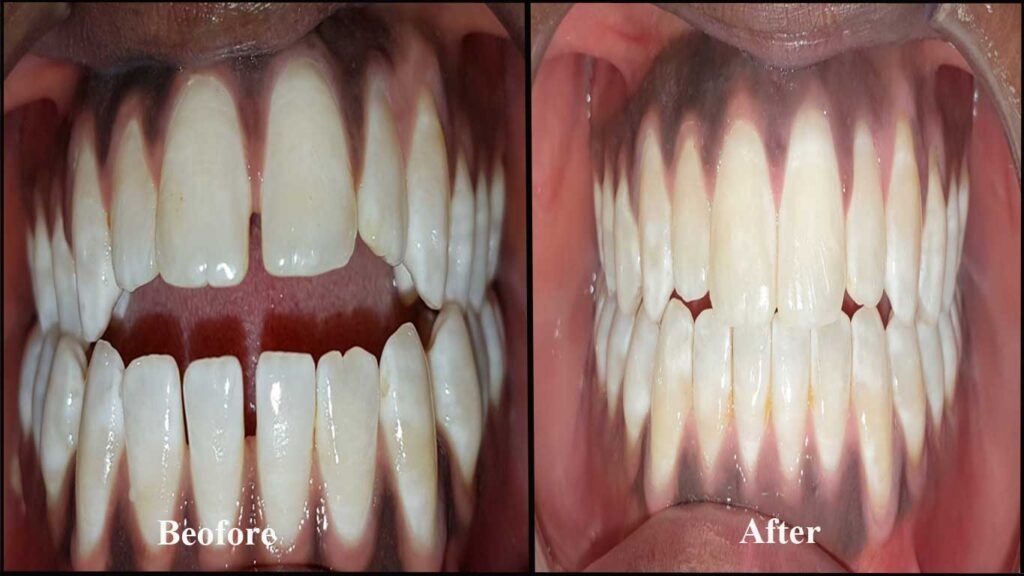 open bite correction-teeth braces before and after