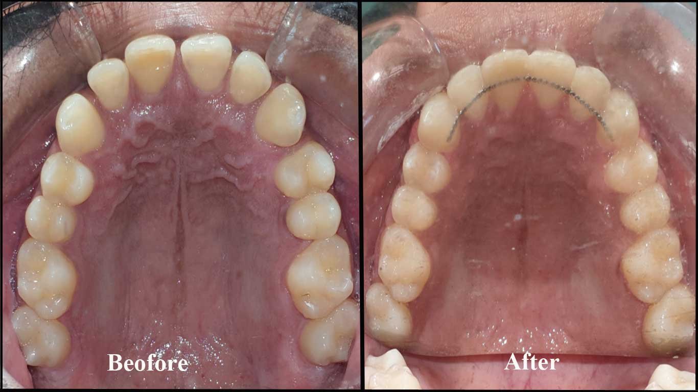 spaced teeth-orthodontics before and after