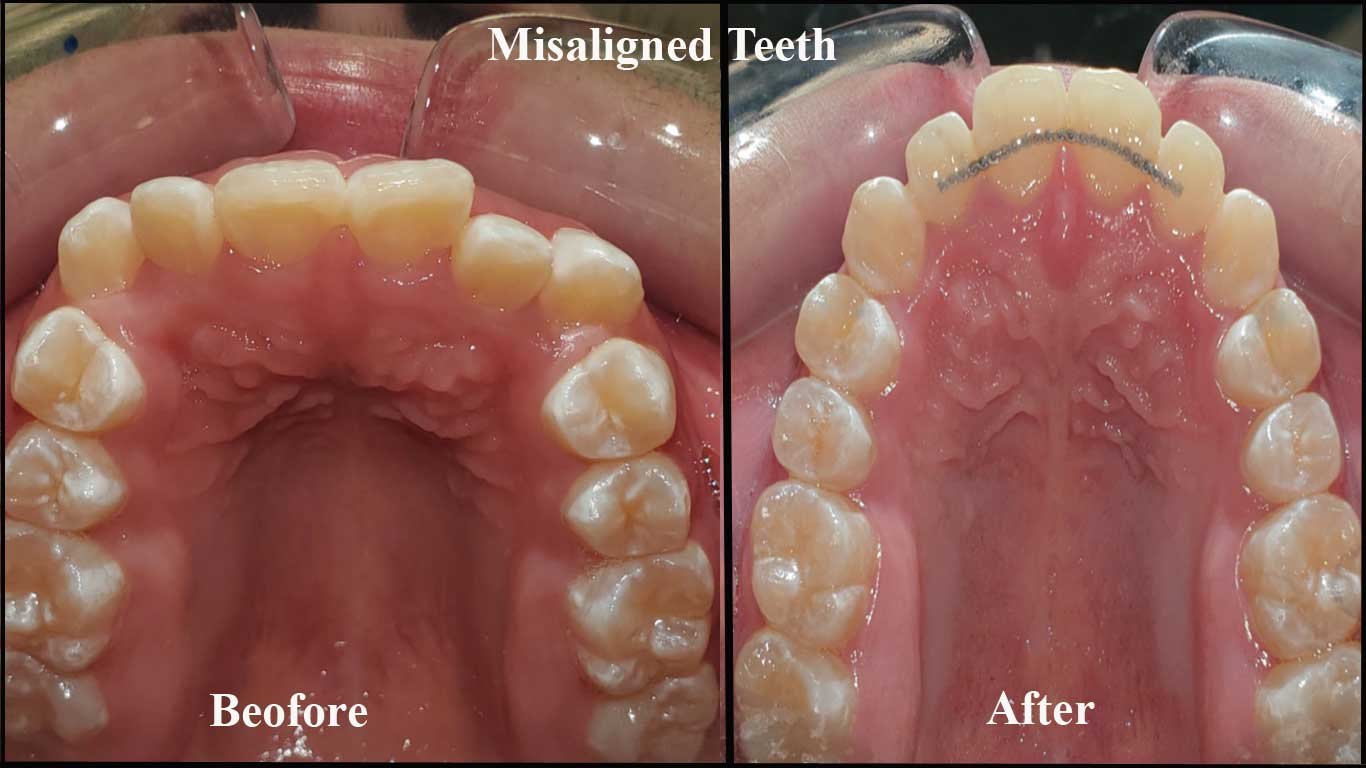 Braces before and after