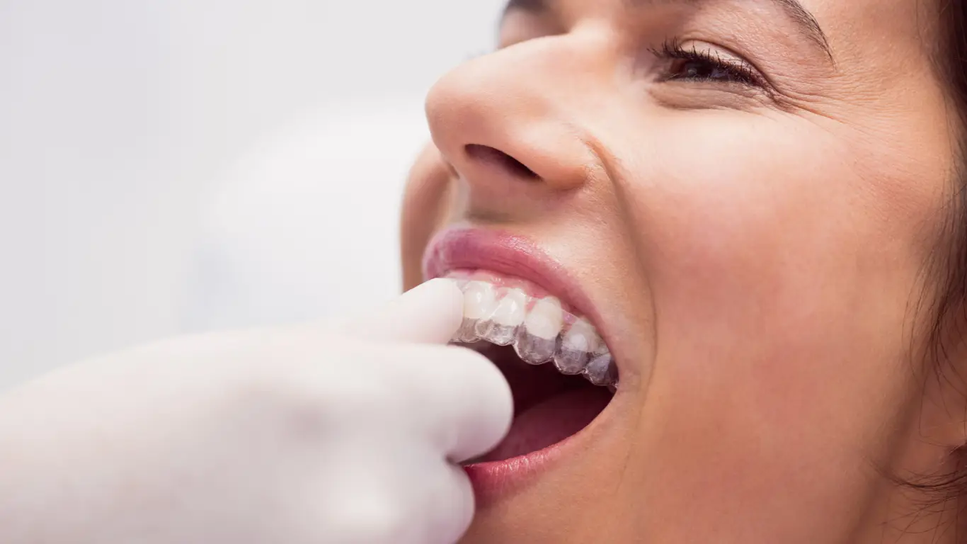 best Invisalign Toronto