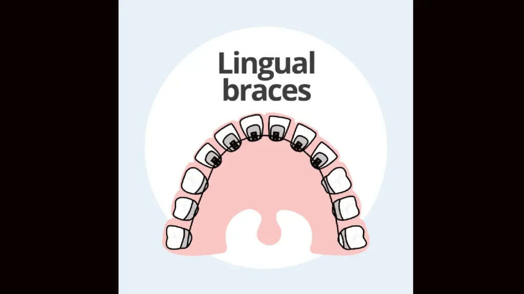 braces on back of teeth- lingual braces