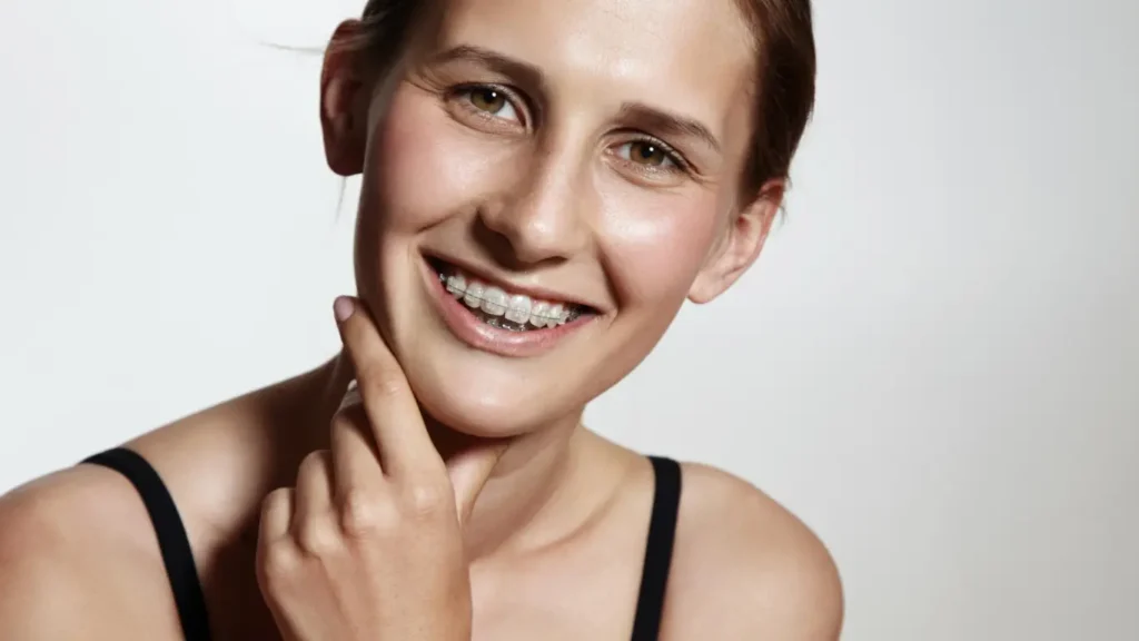 Braces with Ceramic Brackets