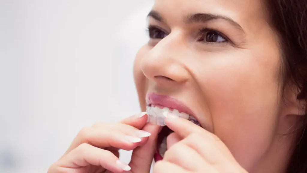 retainer after Invisalign