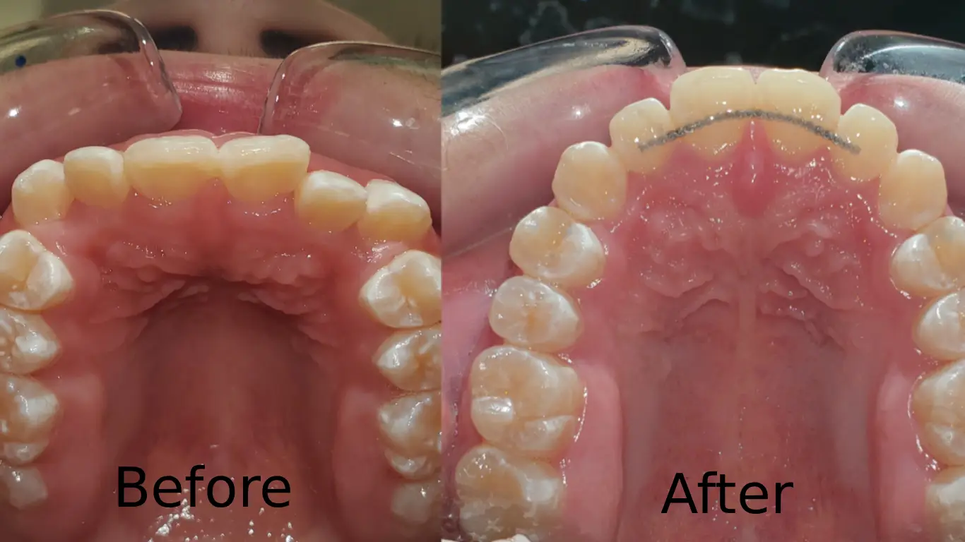 metal mouth braces- before & after