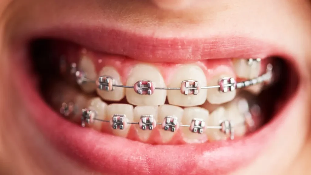 metal teeth braces