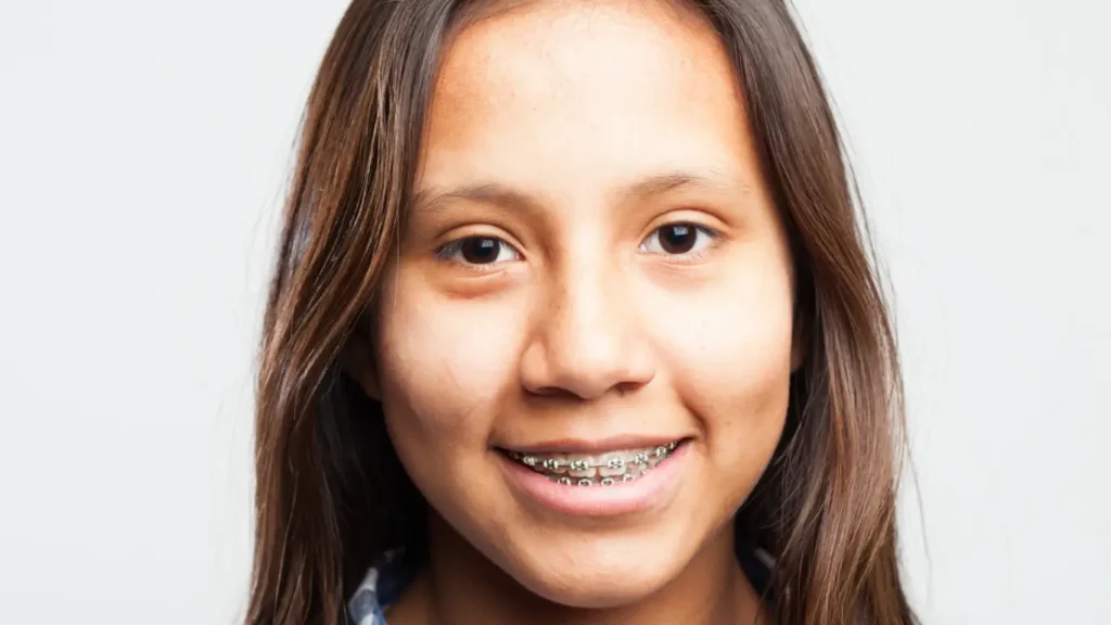 braces before and after jawline