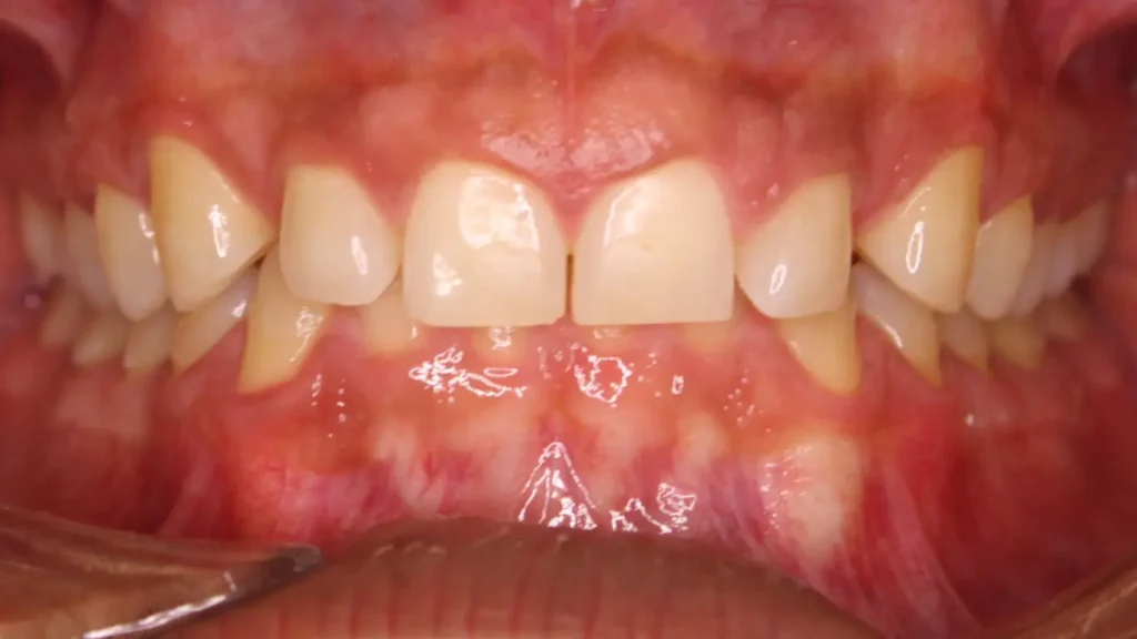 overbite and deep bite