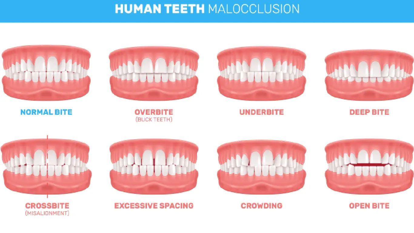 different kinds of malocclusions