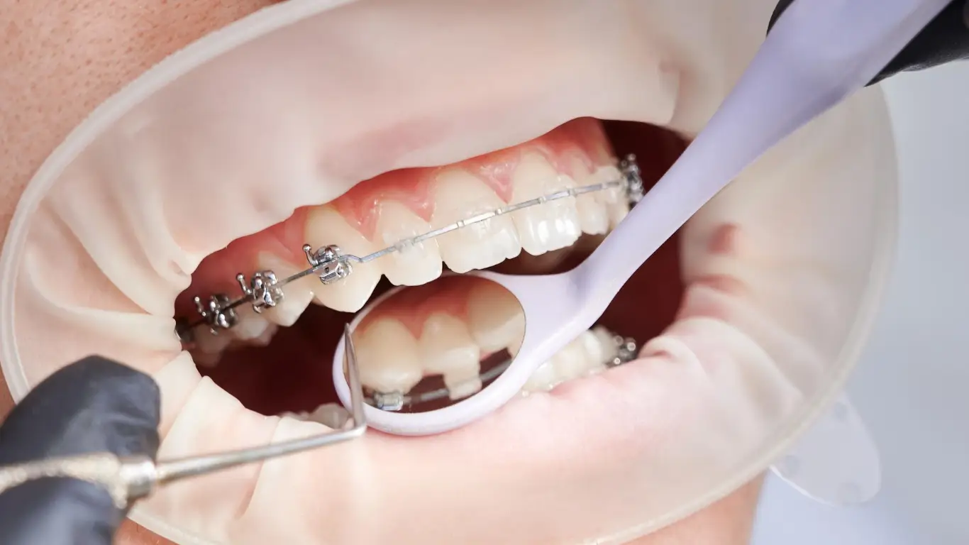 transparent orthodontic braces on front teeth