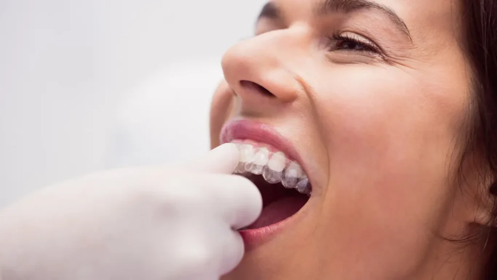 benefits of Invisalign for adults